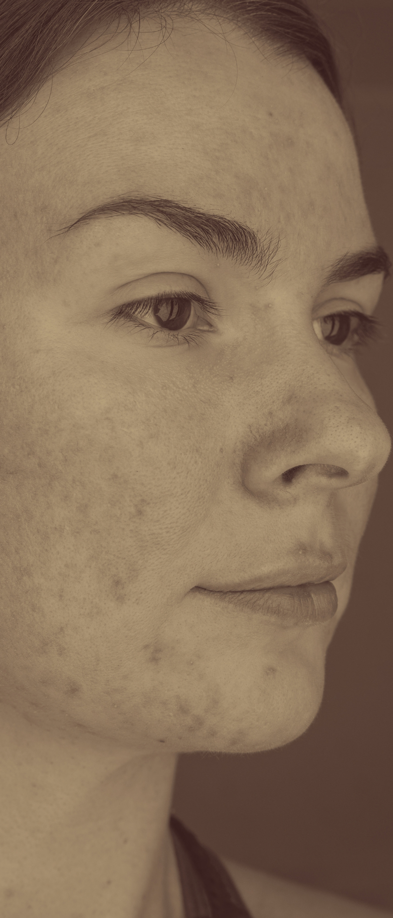 woman with rosacea on her face