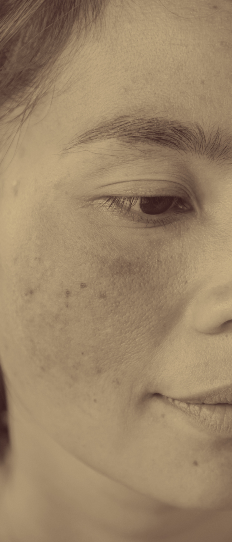 woman with hyperpigmentation